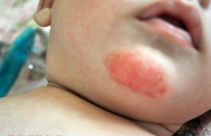 дерматит у ребенка